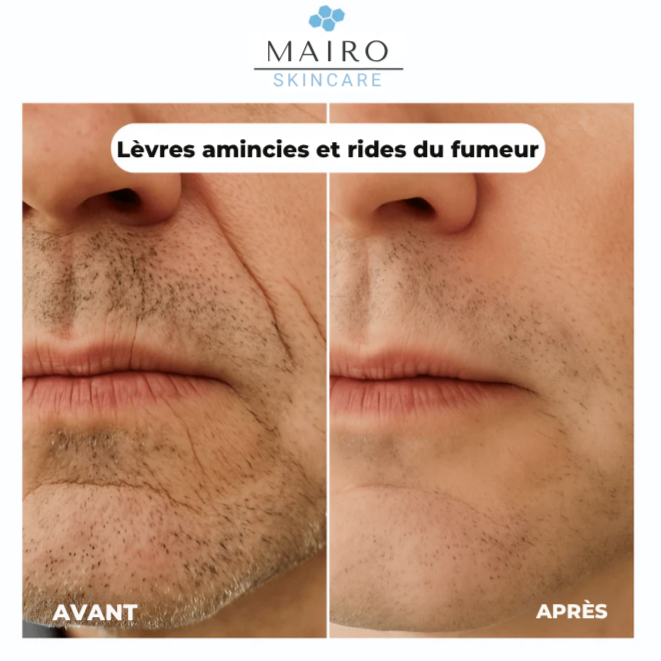 Système Anti-Rides au Collagène Nano-Soie Lyophilisé